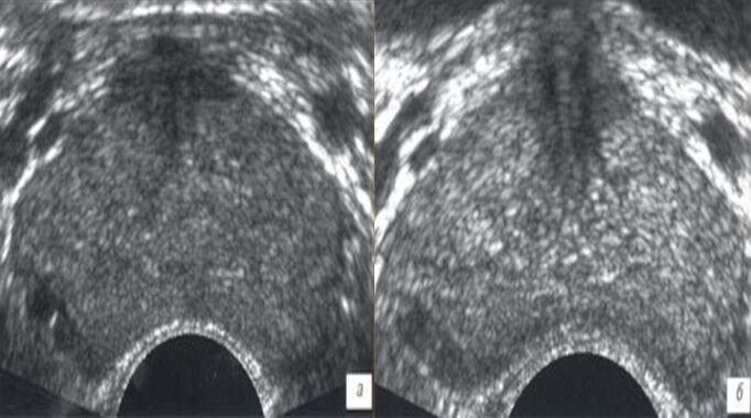 Ultraschall virun an no der Behandlung mat Prostovit Drëpsen